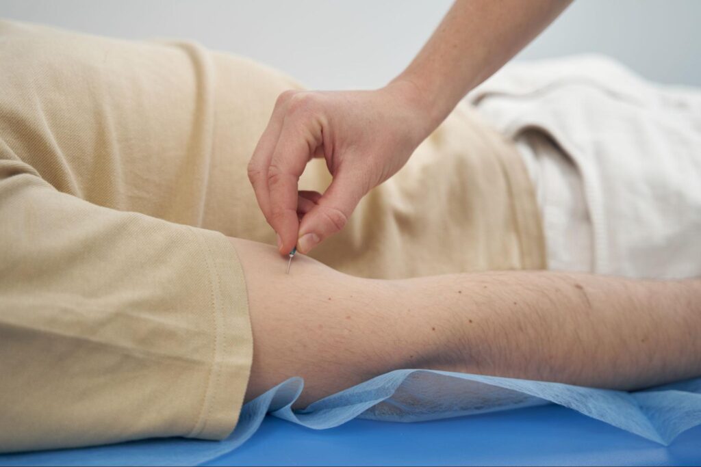 Man undergoing acupuncture and lying down on his stomach.