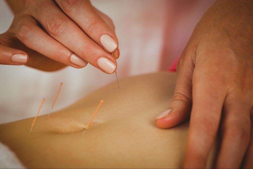 A close-up of a young woman's abdomen receiving acupuncture treatment for weight loss.
