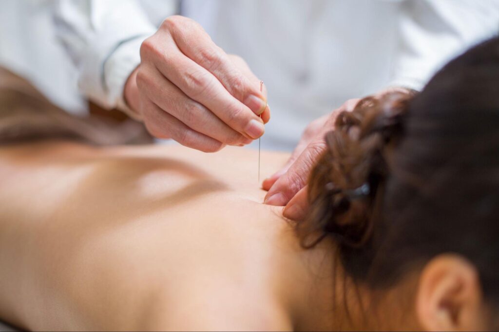 A close-up of an acupuncturist's hand carefully inserting a thin needle into a young woman's back during an acupuncture session.