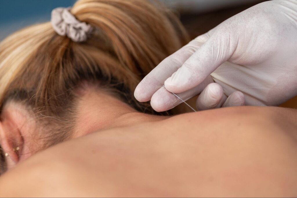 Person in gloves putting an acupuncture needle into a woman’s back.