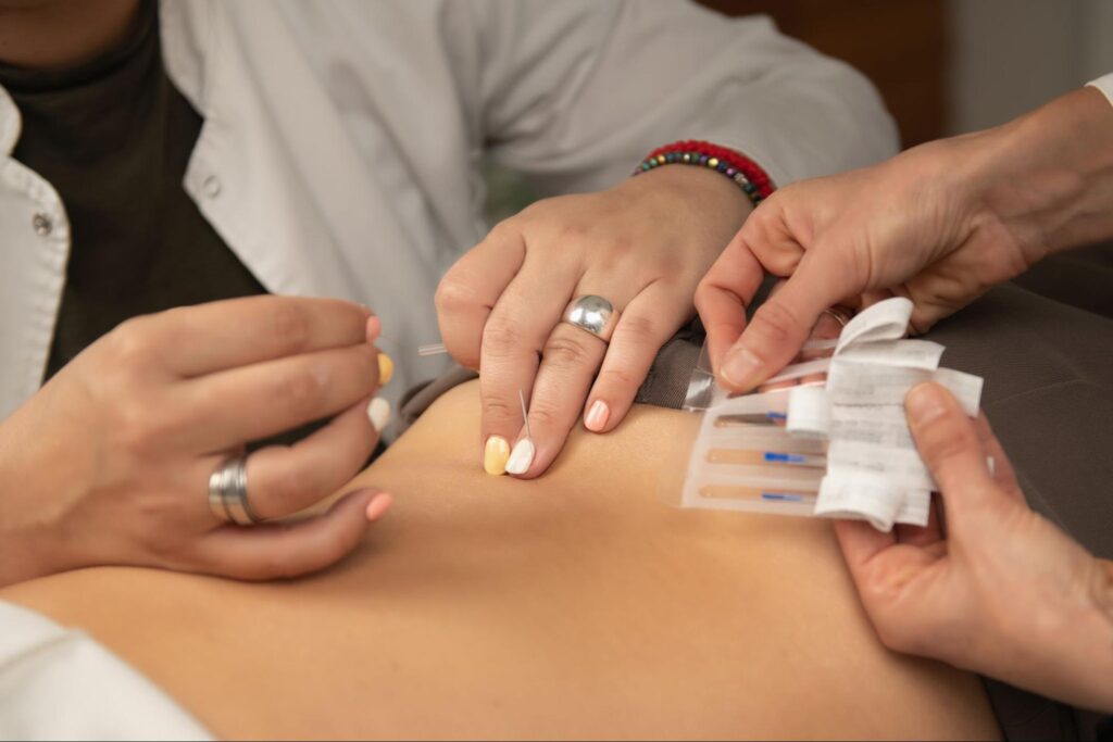 A close-up of acupuncture needles inserted into the lower back for sciatica pain relief. Acupuncturists performing back pain acupuncture on a patient.