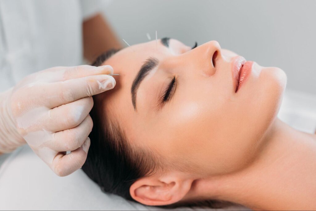 Facial acupuncture, as shown in the image, involves precisely placing fine needles on the face to stimulate natural skin rejuvenation.
