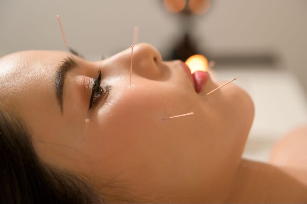 A close-up view of a woman receiving facial acupuncture.